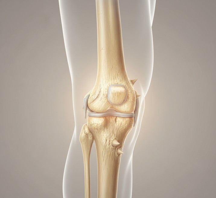Medical illustration of a human knee with osteoarthritis, showing worn cartilage, narrowed joint space, and bone spurs.