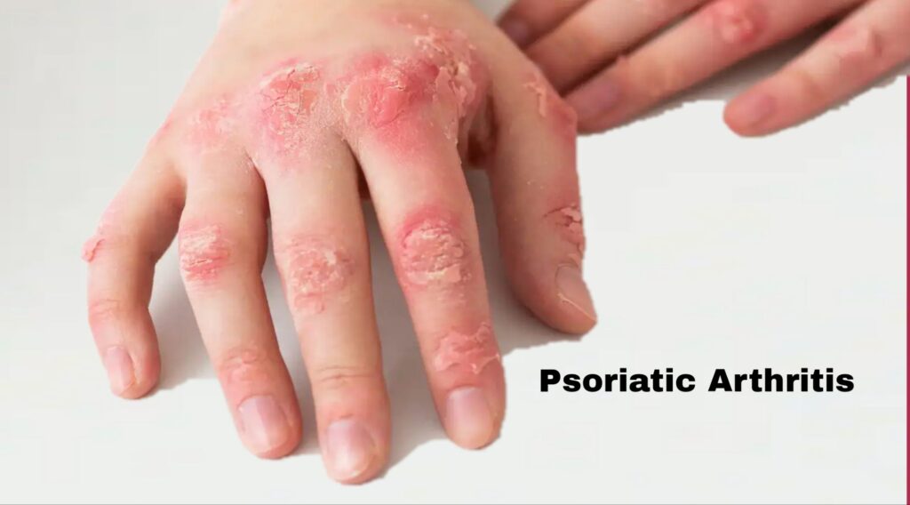 Person with Psoriatic Arthritis showing swollen joints and psoriasis patches on skin.