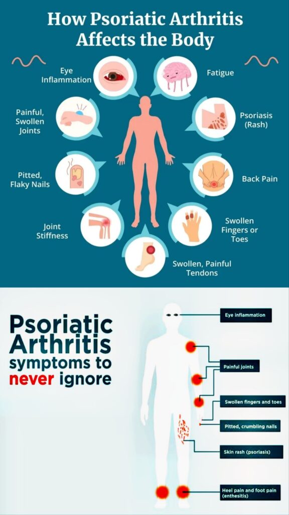 Psoriatic Arthritis how affect body and his symptoms in hindi 
