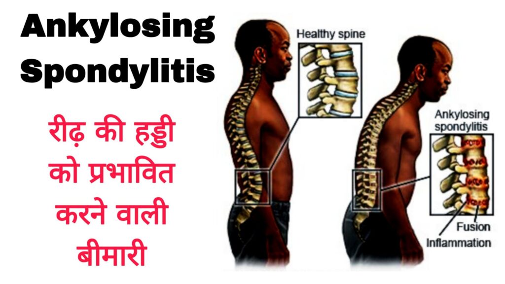 Man suffering from Ankylosing Spondylitis showing spine inflammation