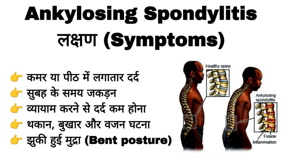 Ankylosing Spondylitis के लक्षण (Symptoms)